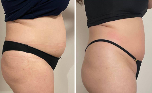 Remodelare corporală Kindomed Timișoara